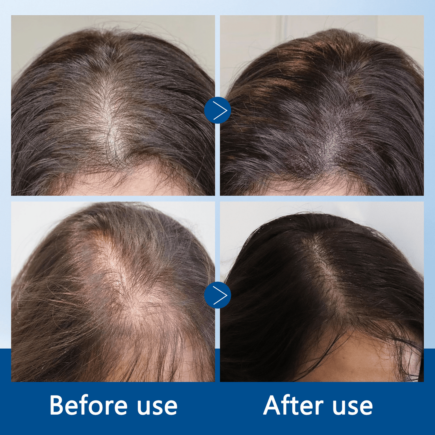 Close‑up of roller tip delivering serum to scalp in precise micro‑dose.